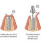 Dental Implant