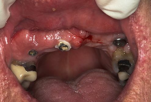 Broken abutment