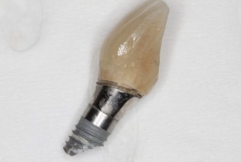 Broken implant