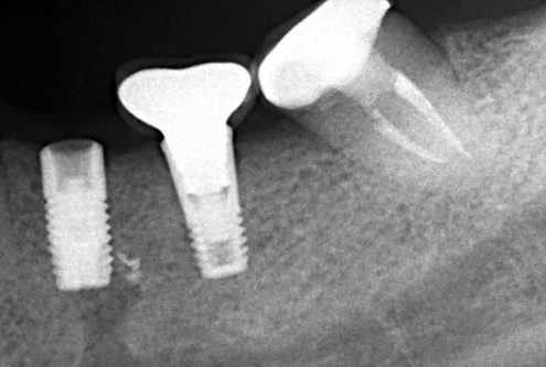 Broken screw
