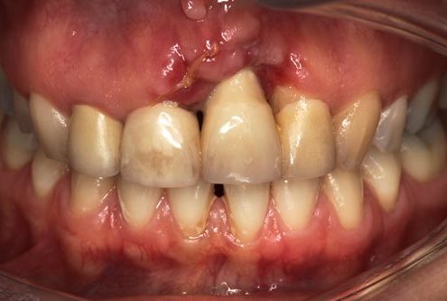 Untreated Complication