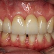 Treated Complication