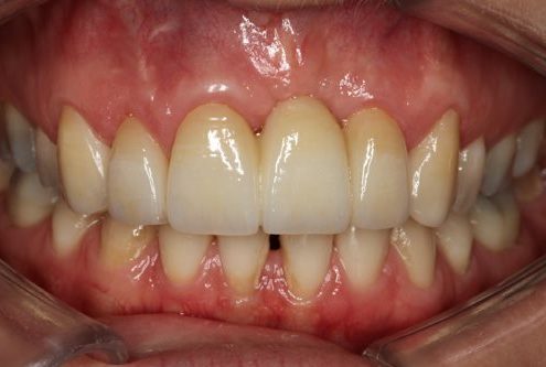 Treated Complication