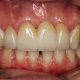 Treated Complication