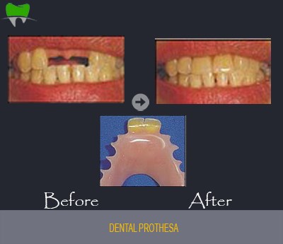 Dental prothesa